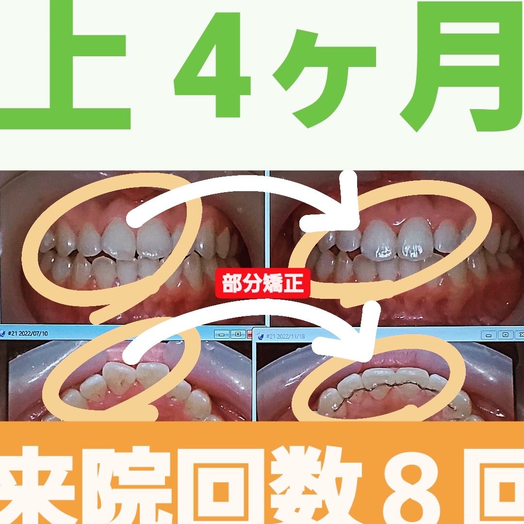 出っ歯＋叢生＋非抜歯矯正