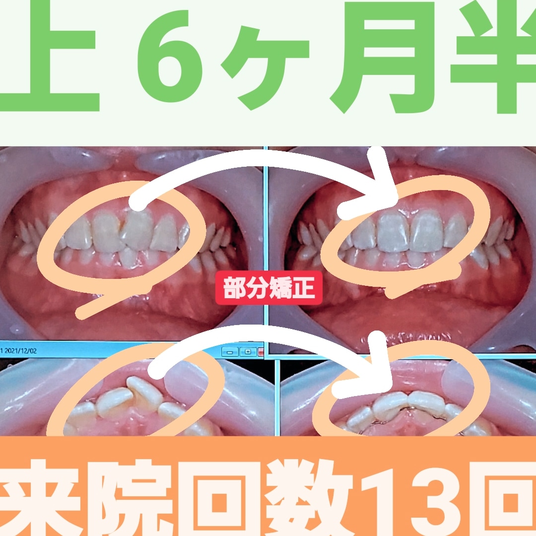 出っ歯＋叢生＋非抜歯矯正