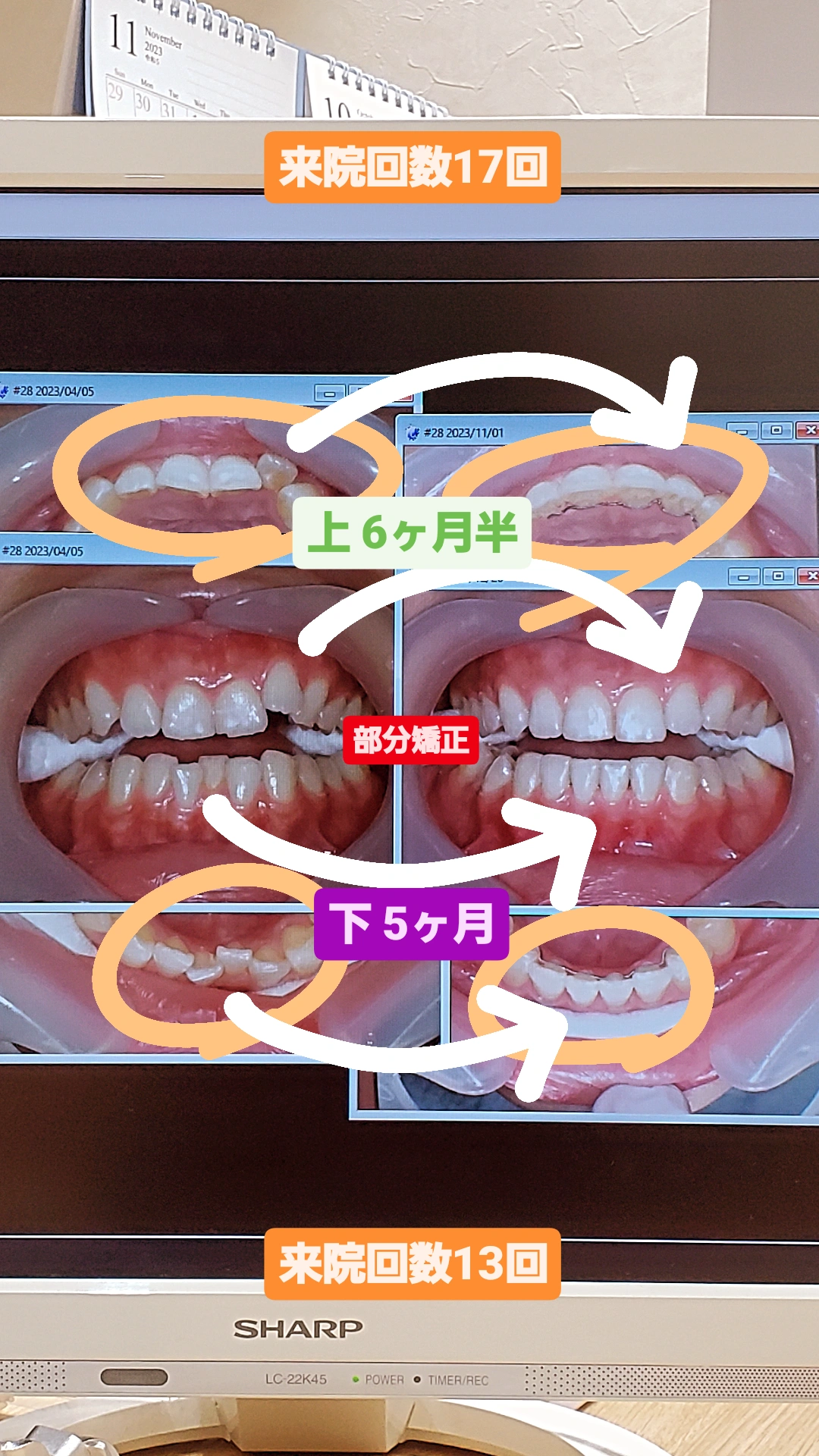 出っ歯＋叢生＋非抜歯矯正
