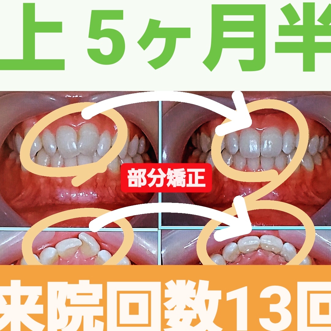 出っ歯＋叢生＋非抜歯矯正