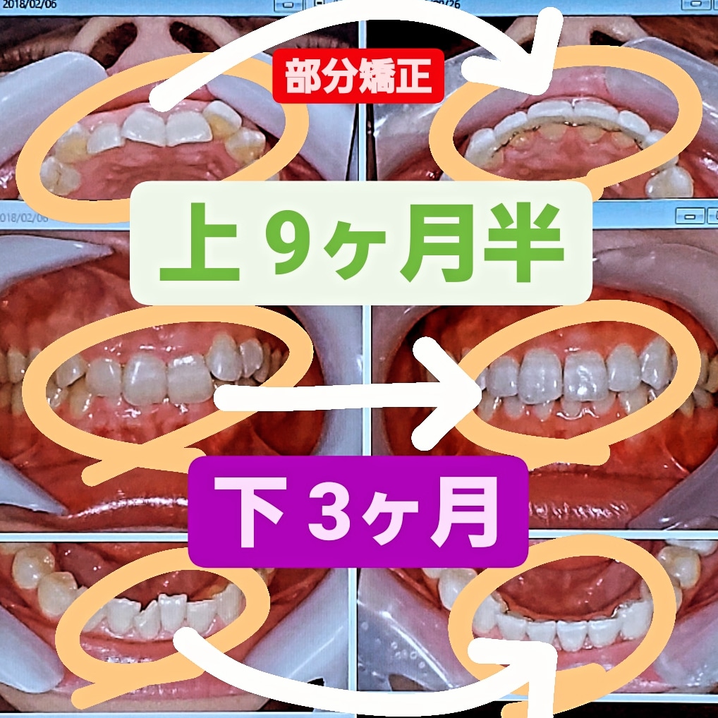 出っ歯＋叢生＋非抜歯矯正