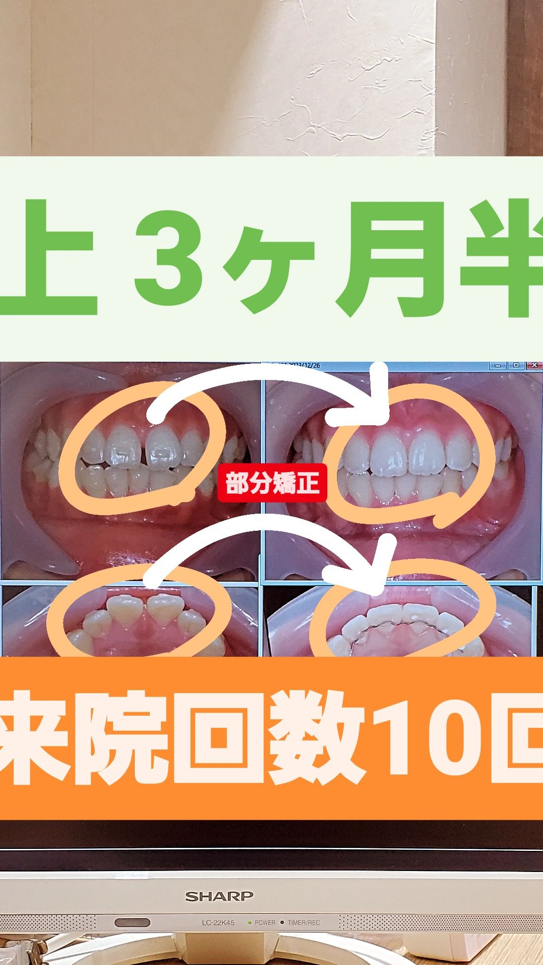 出っ歯+すきっ歯＋非抜歯矯正