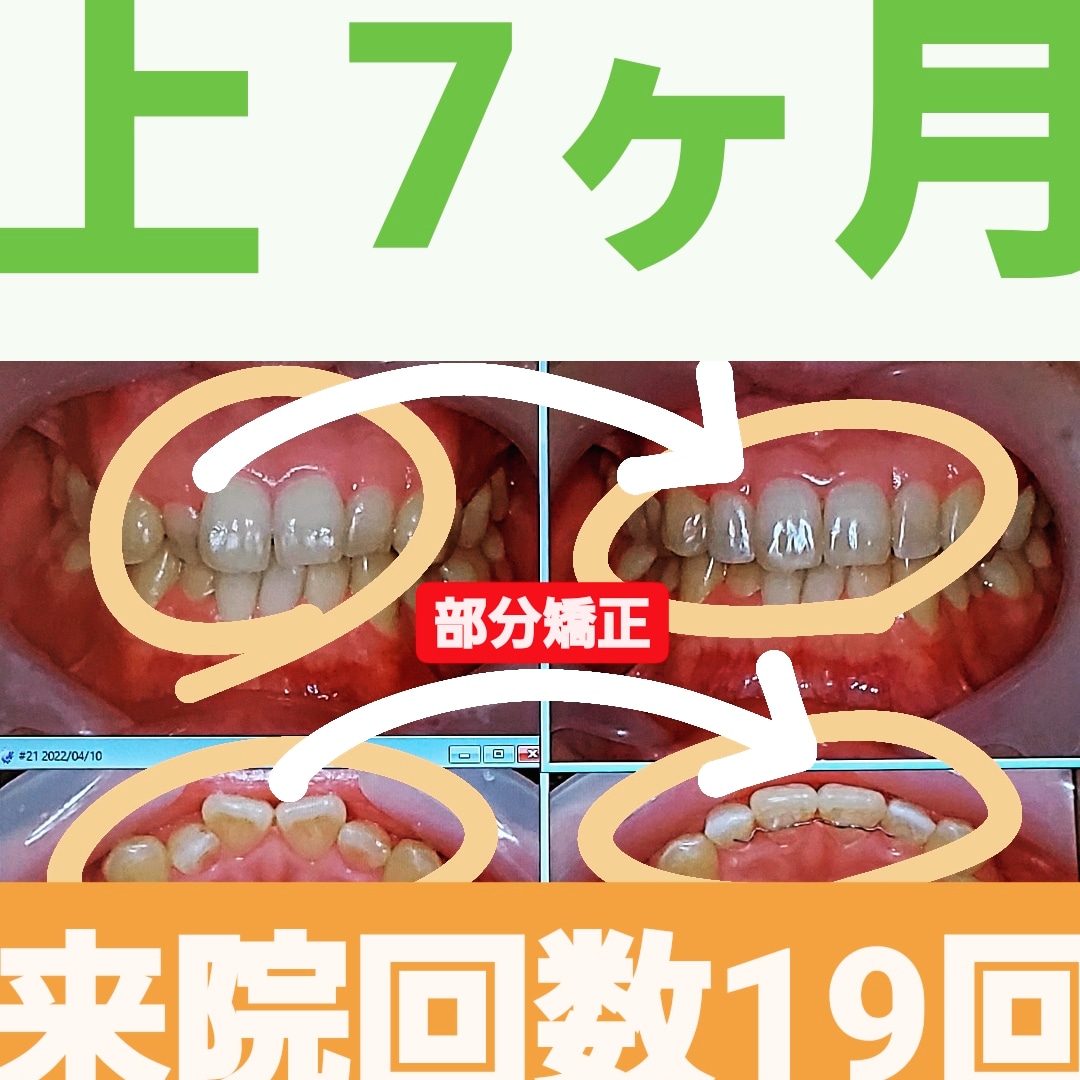 叢生＋非抜歯矯正