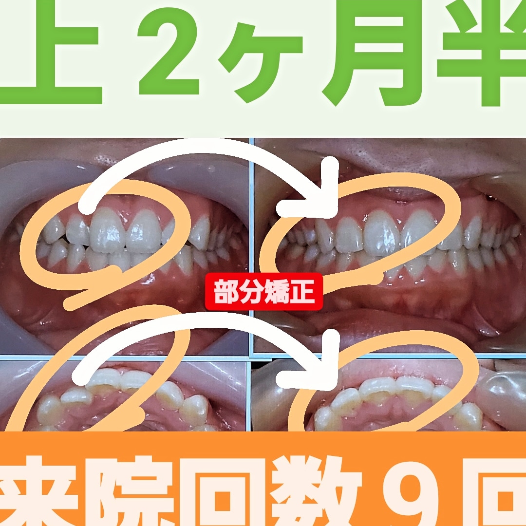 叢生＋非抜歯矯正