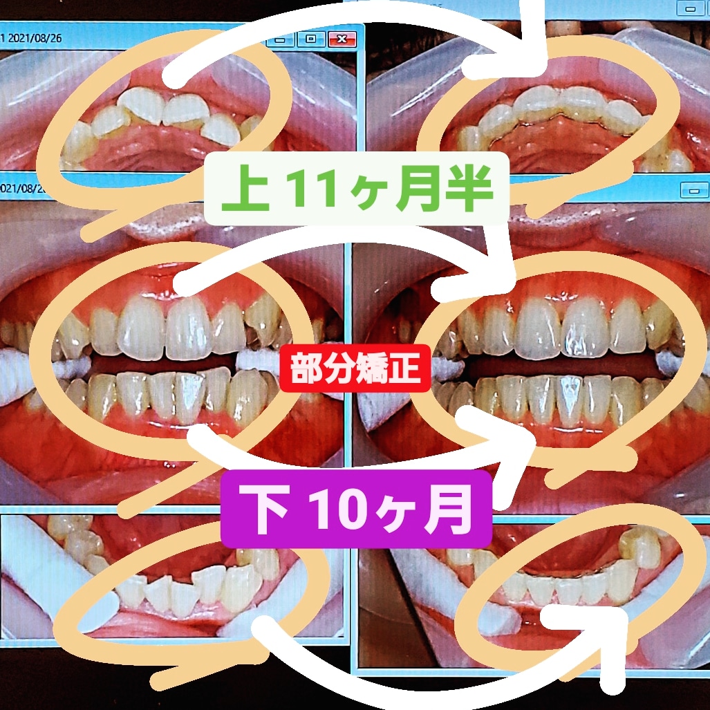 出っ歯＋叢生＋少し八重歯＋非抜歯矯正