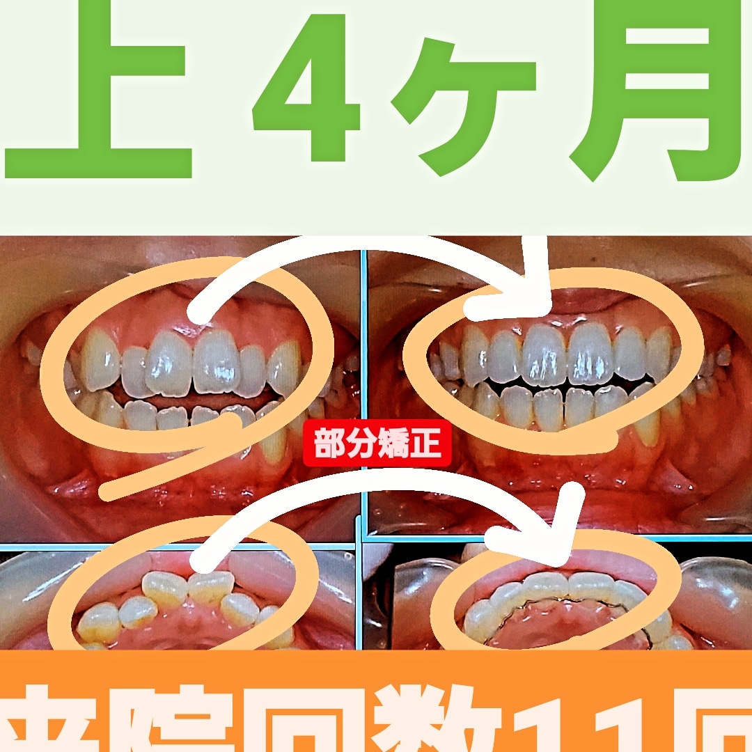 出っ歯＋叢生＋非抜歯矯正