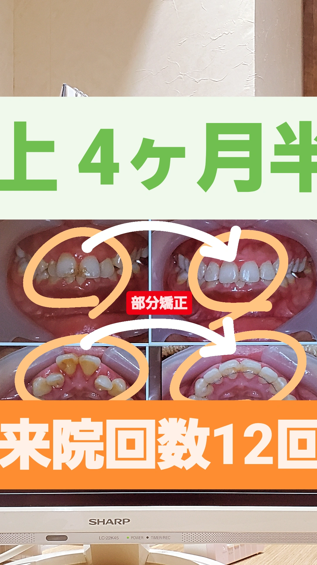 出っ歯＋非抜歯矯正