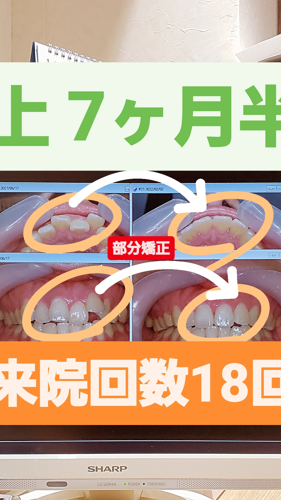 出っ歯＋叢生＋非抜歯矯正