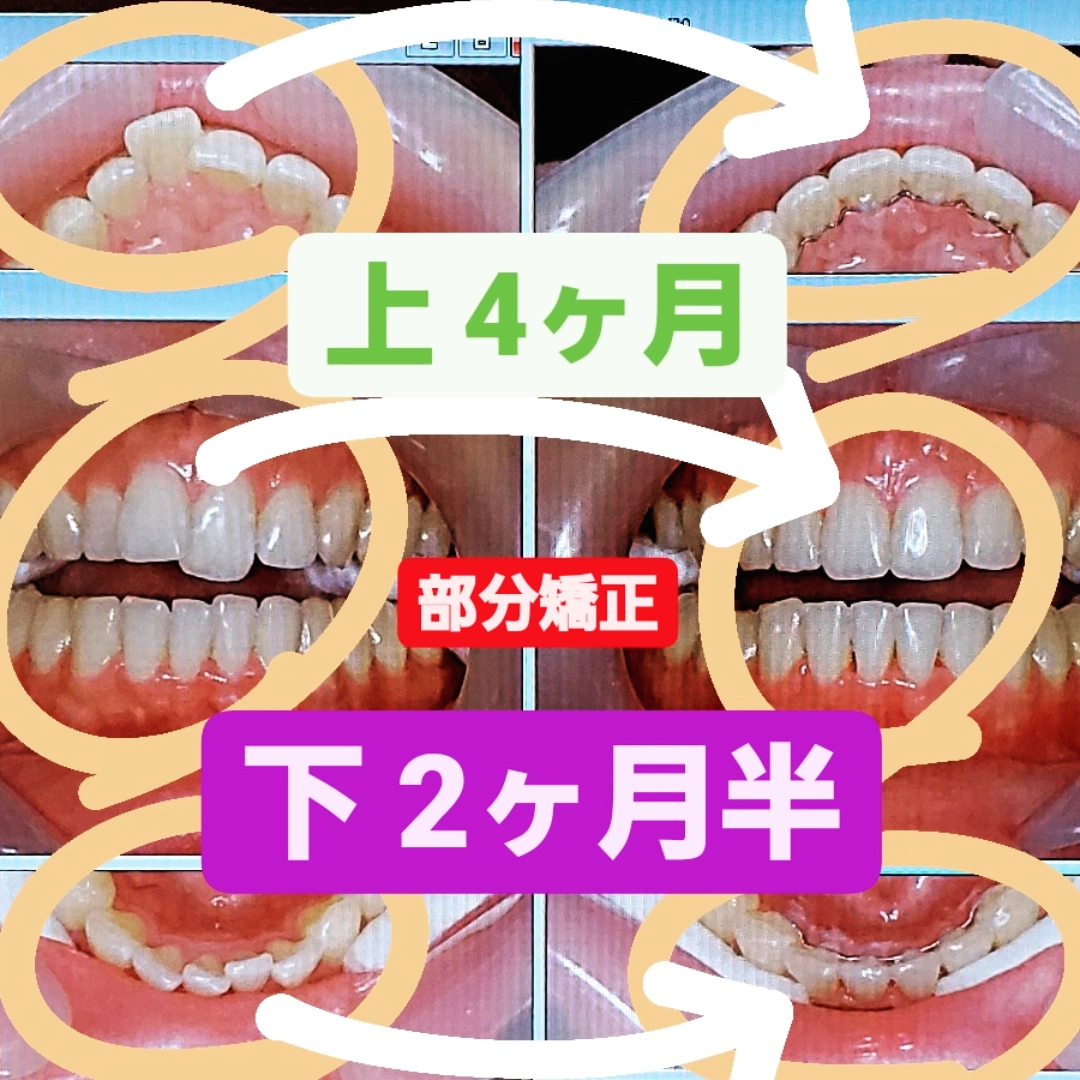 出っ歯＋叢生＋非抜歯矯正