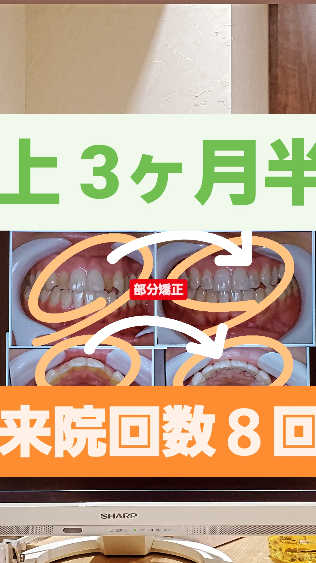 部分的な反対咬合＋非抜歯矯正