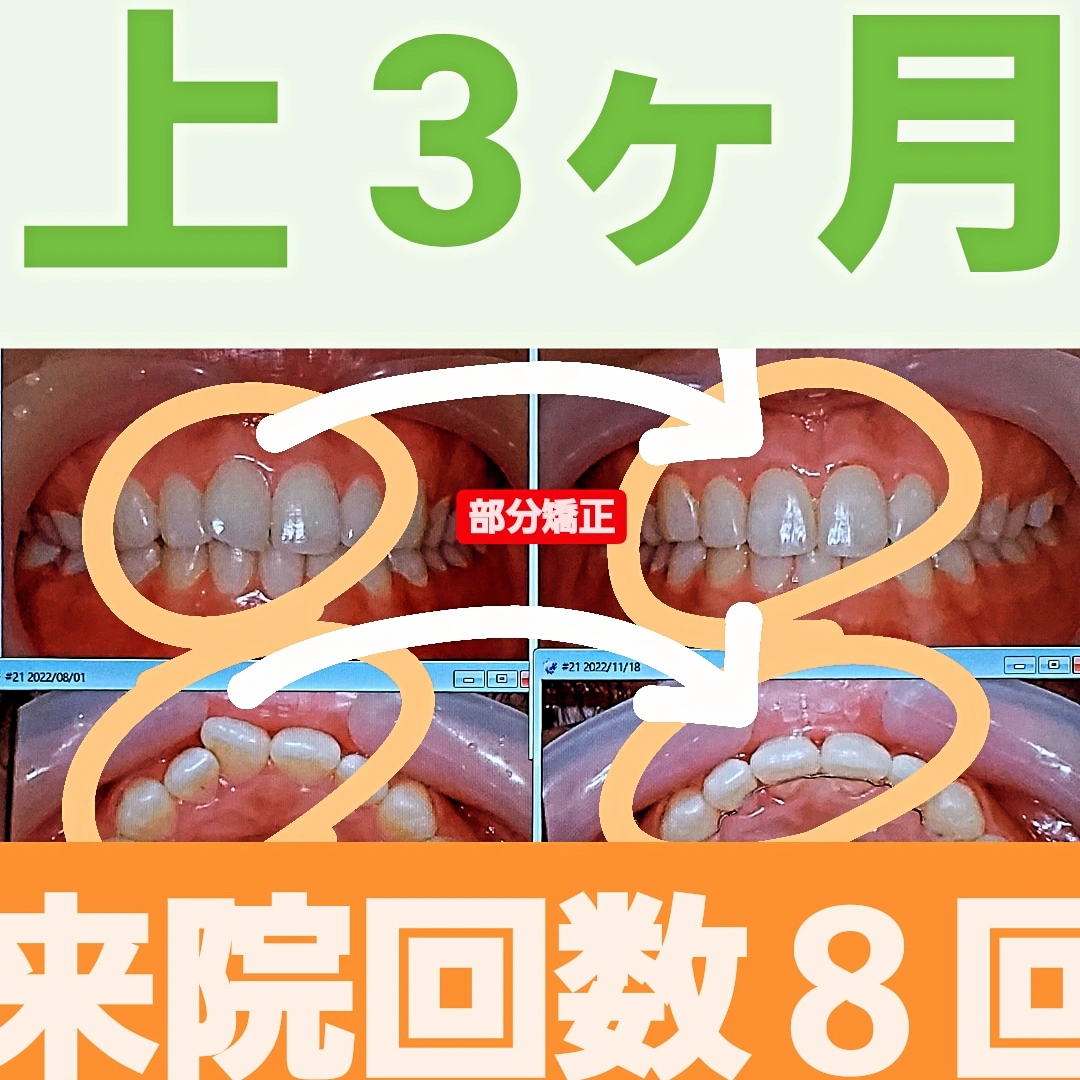 叢生＋非抜歯矯正