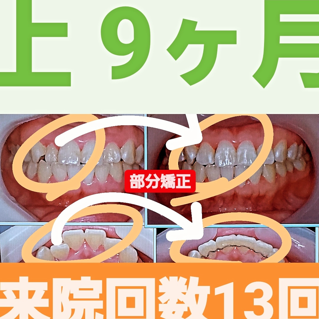 部分的な反対咬合＋叢生＋非抜歯矯正