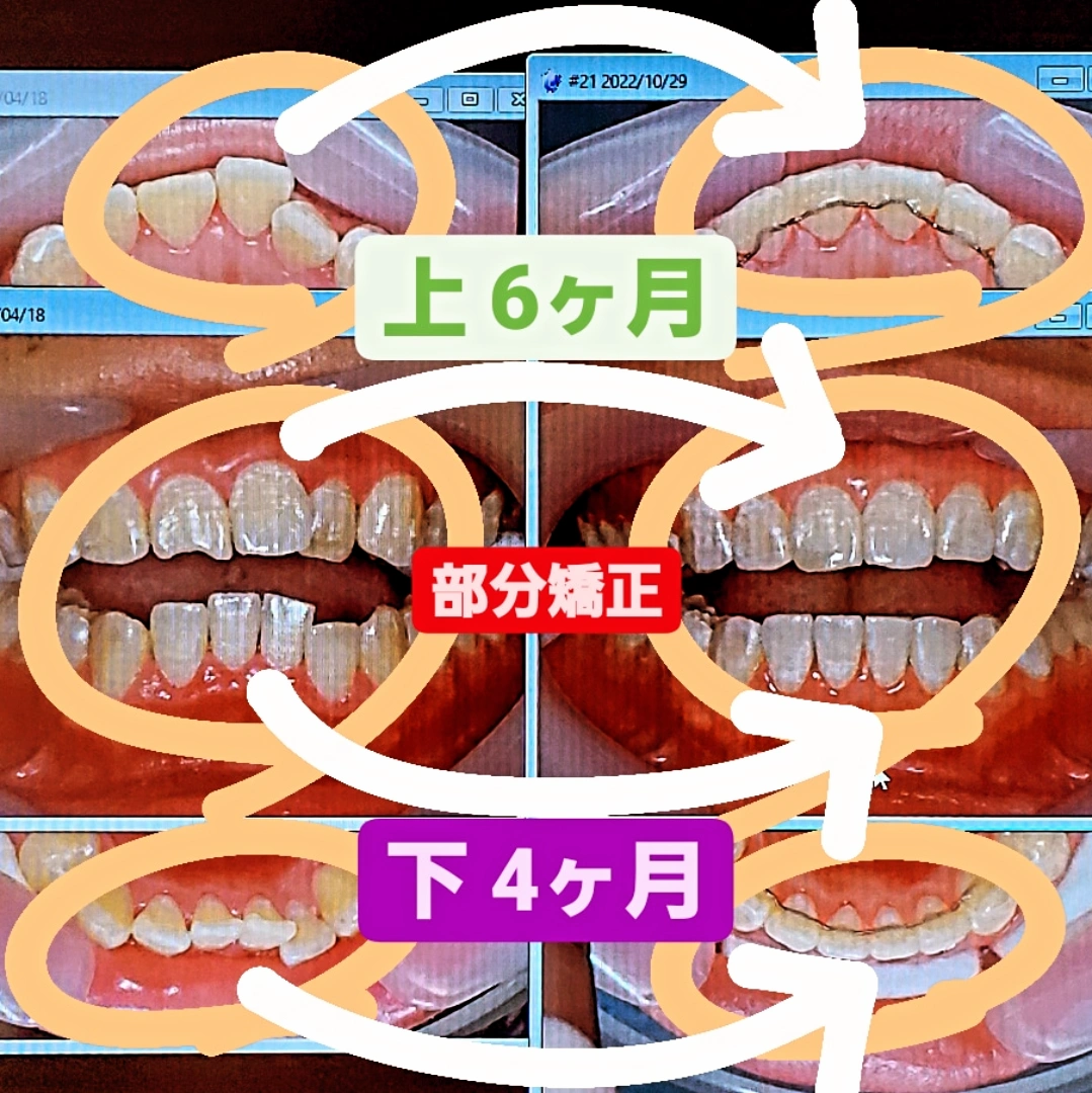 部分的な反対咬合＋すきっ歯＋非抜歯矯正
