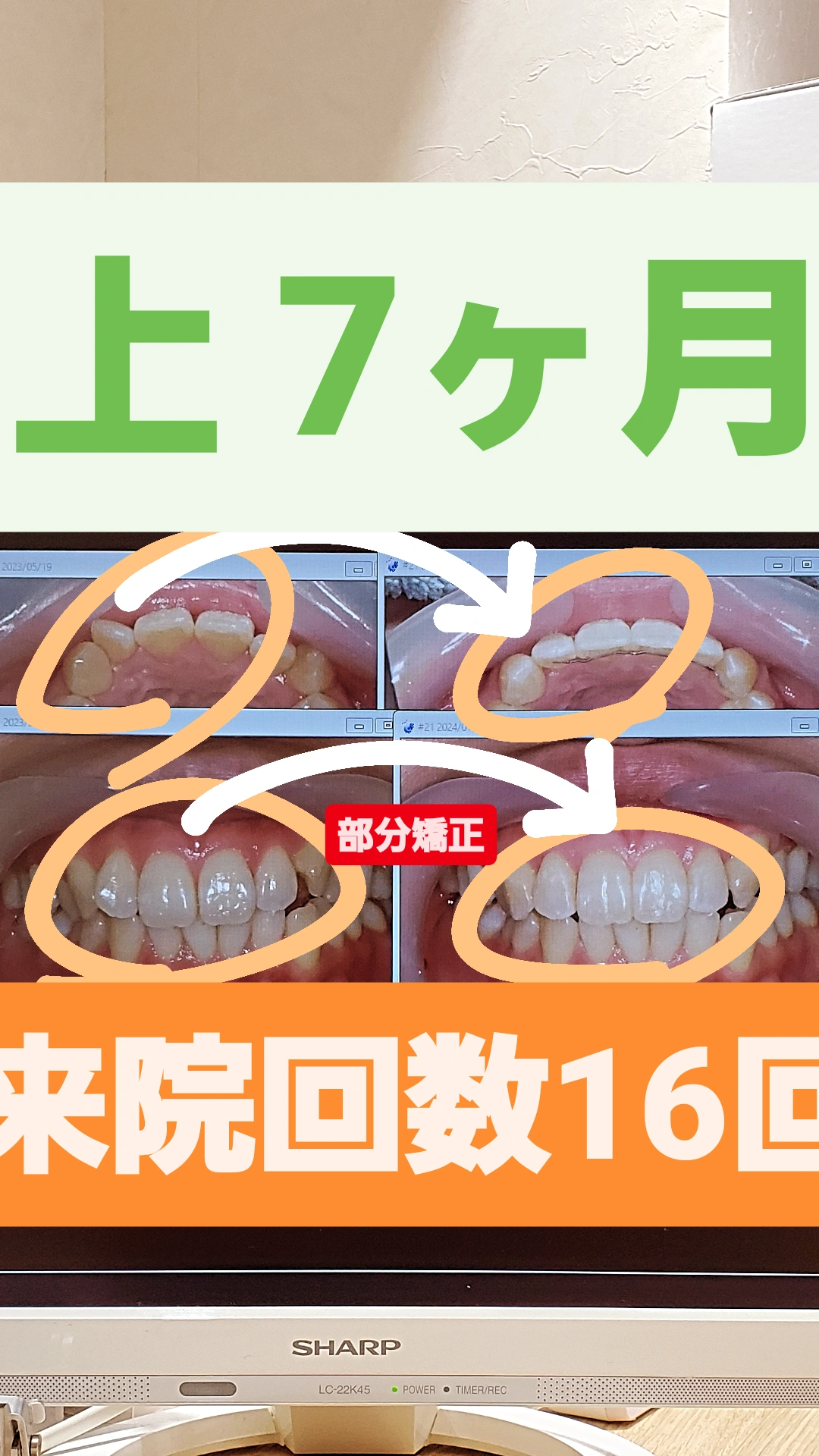 叢生＋非抜歯矯正