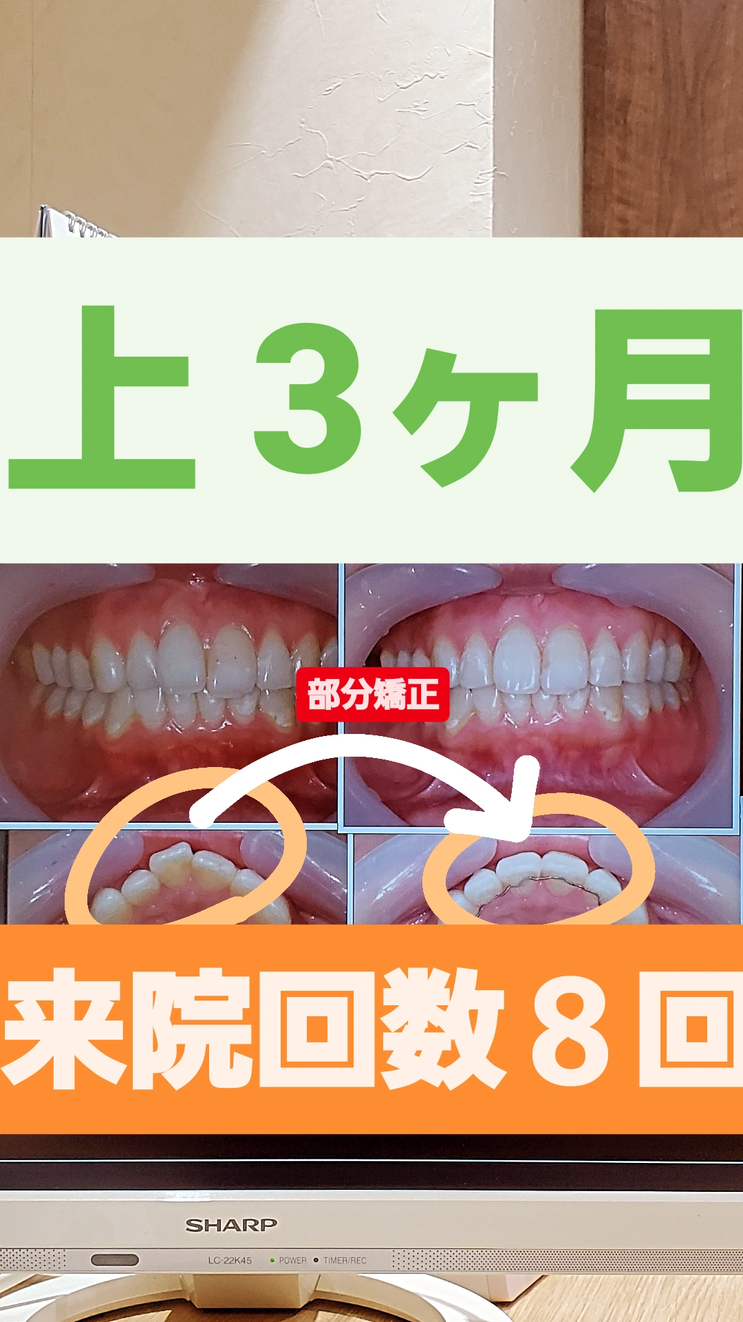 出っ歯＋非抜歯矯正