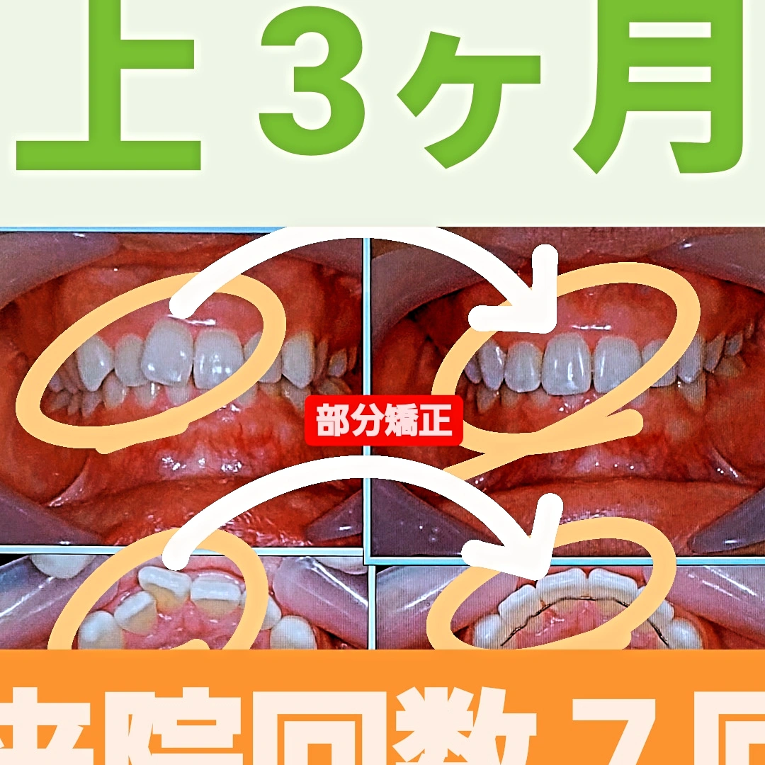叢生＋非抜歯矯正