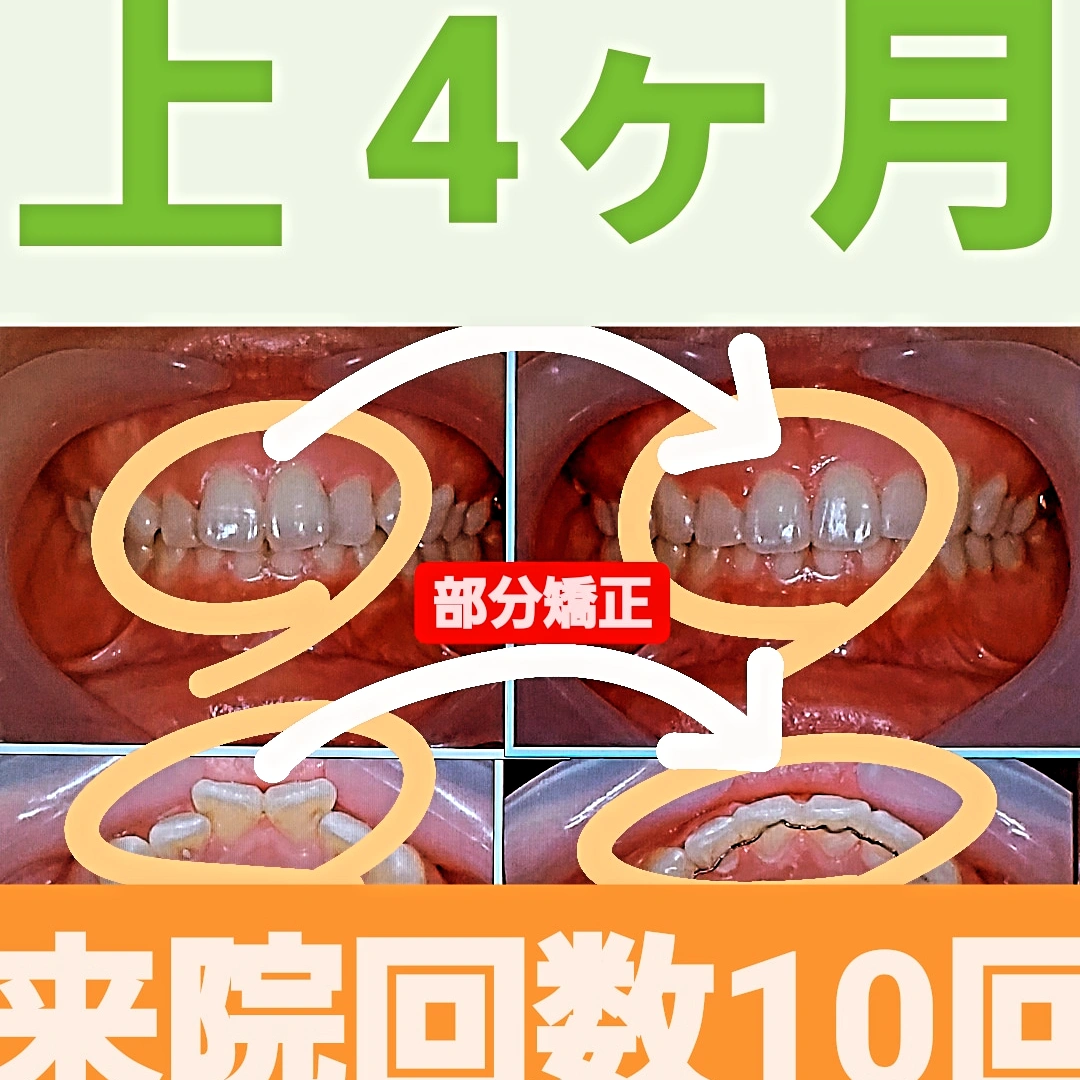 出っ歯＋叢生＋非抜歯矯正