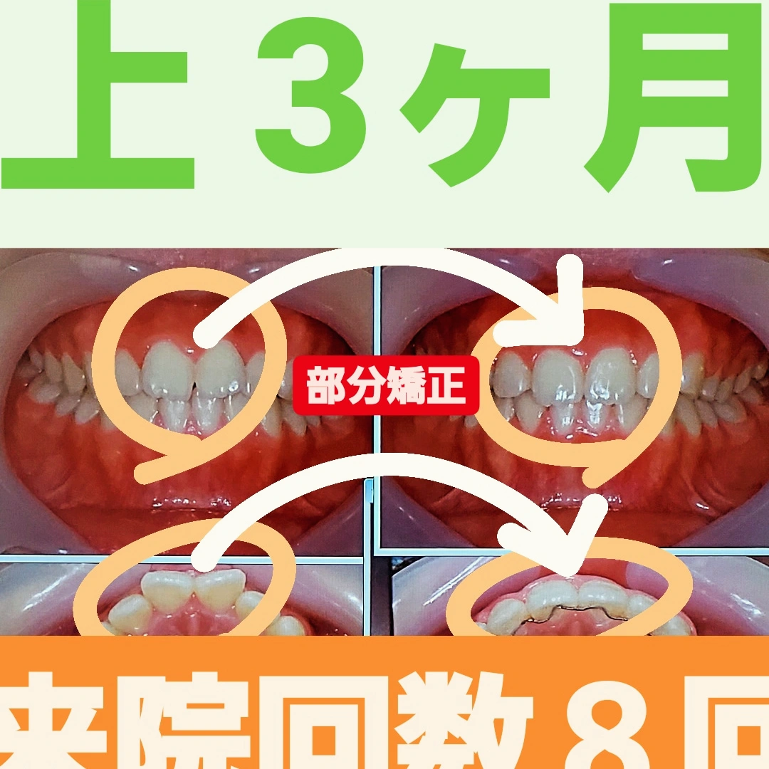 出っ歯+すきっ歯＋非抜歯矯正
