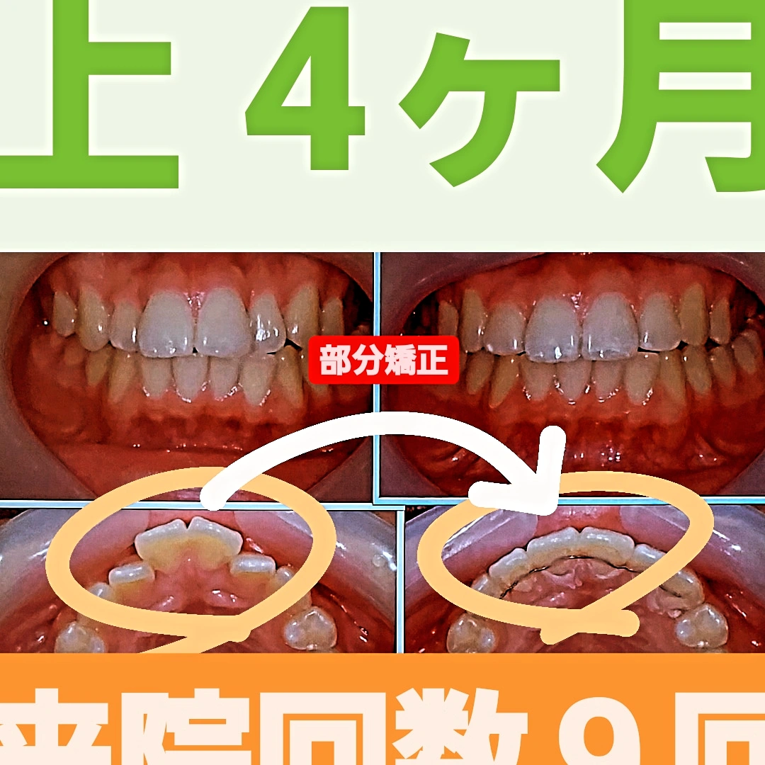 出っ歯＋叢生＋非抜歯矯正