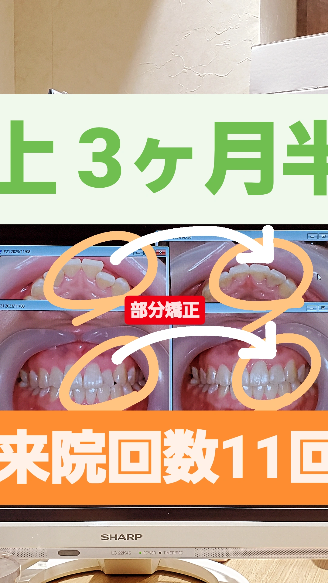 部分的な反対咬合＋非抜歯矯正