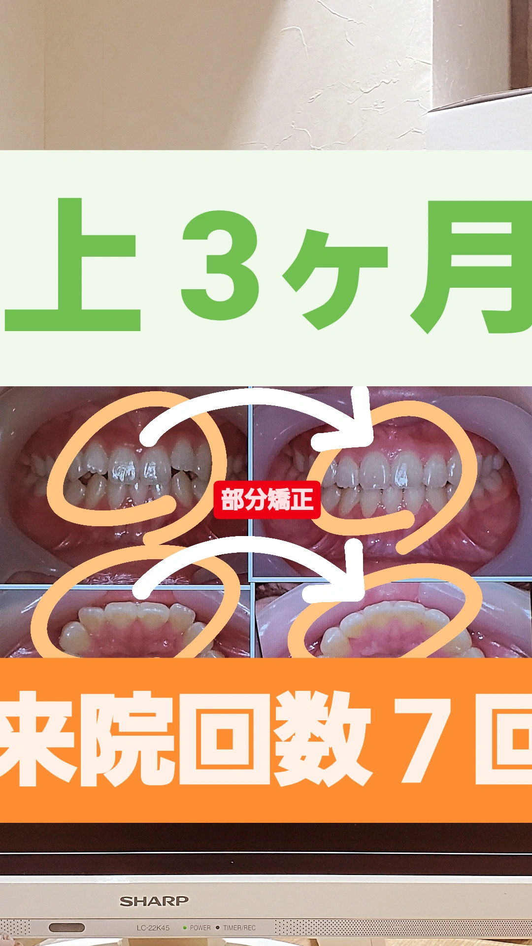 出っ歯＋叢生＋非抜歯矯正