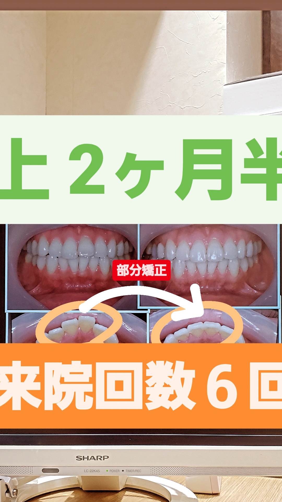 出っ歯＋非抜歯矯正