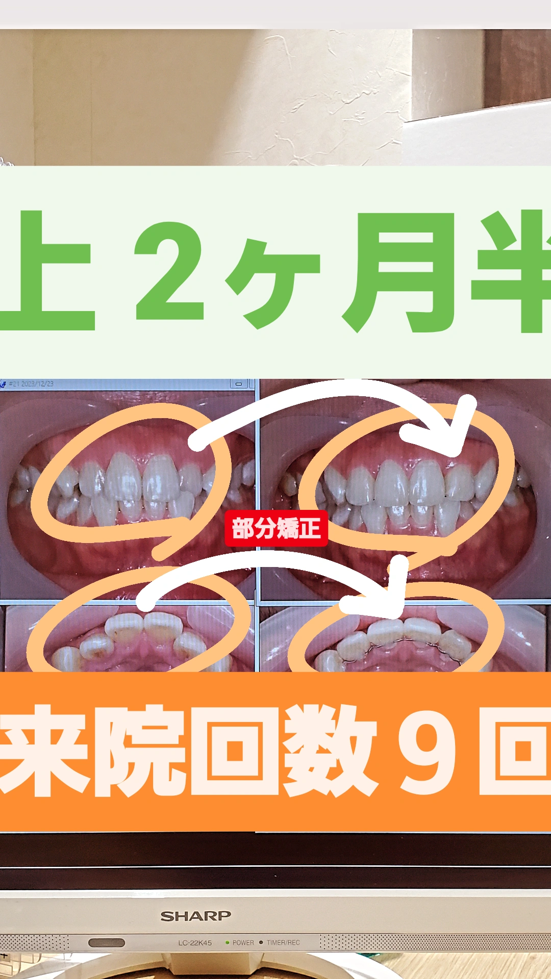 部分的な反対咬合＋非抜歯矯正