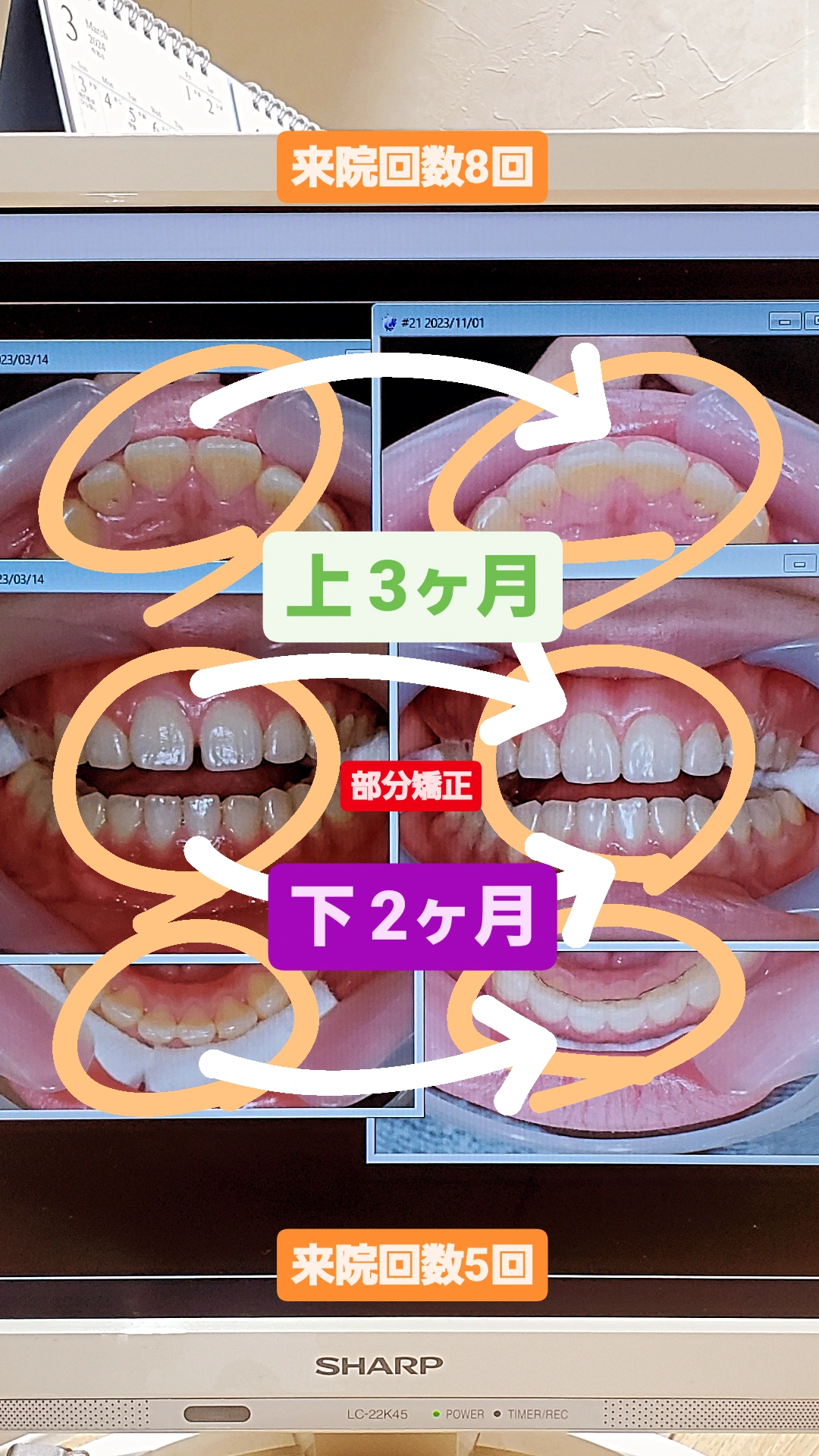 すきっ歯＋非抜歯矯正