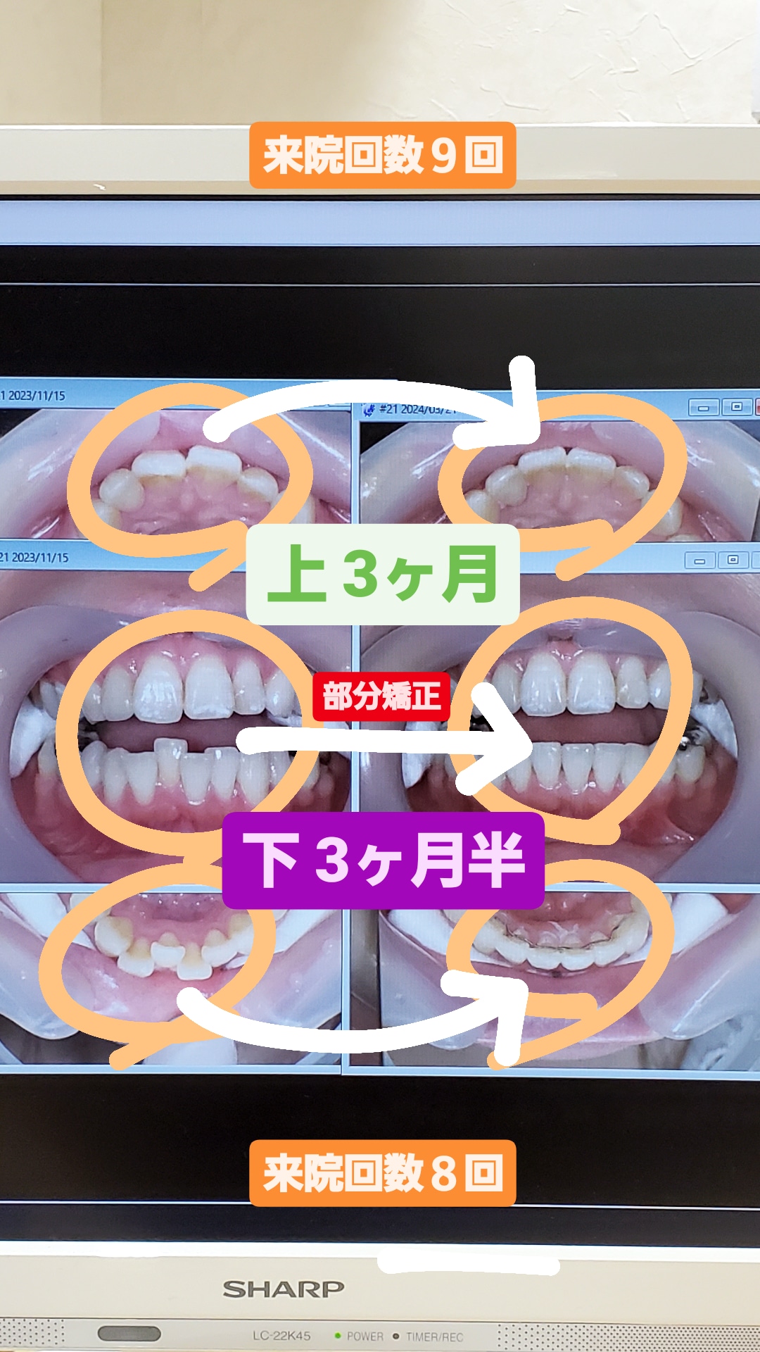 叢生＋非抜歯矯正