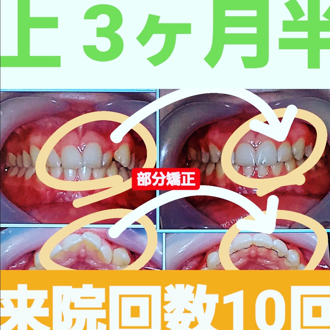 叢生＋非抜歯矯正