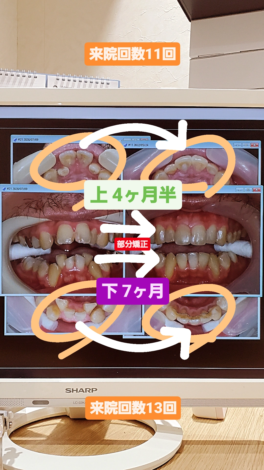 部分的な反対咬合＋叢生＋出っ歯＋非抜歯矯正