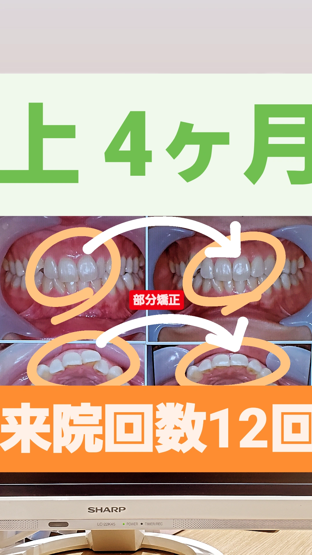 叢生＋非抜歯矯正