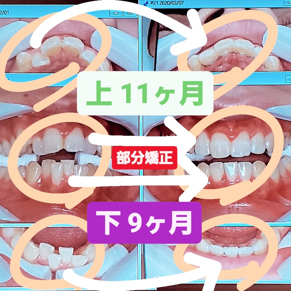 出っ歯＋叢生＋非抜歯矯正