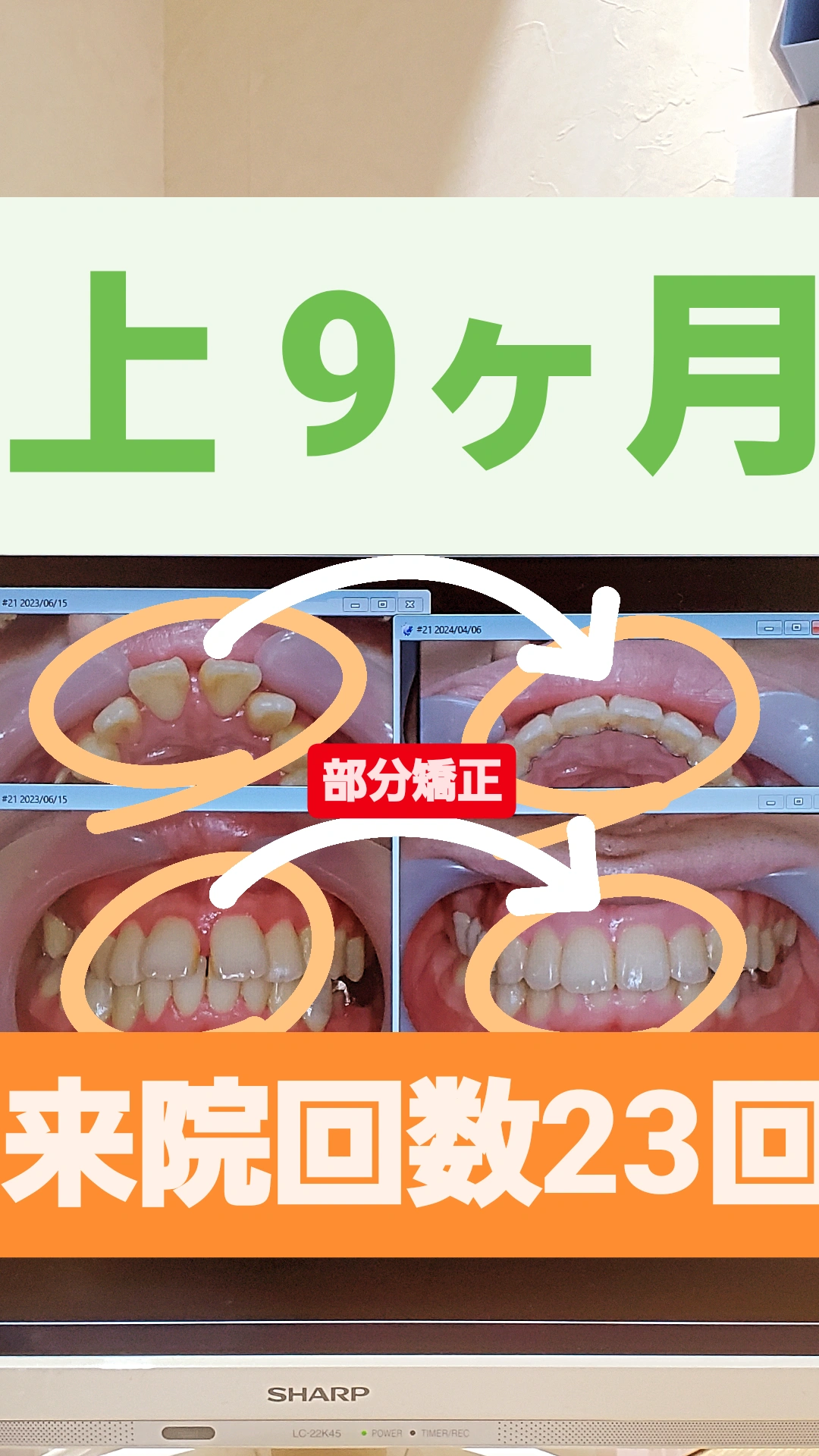 出っ歯+すきっ歯＋非抜歯矯正