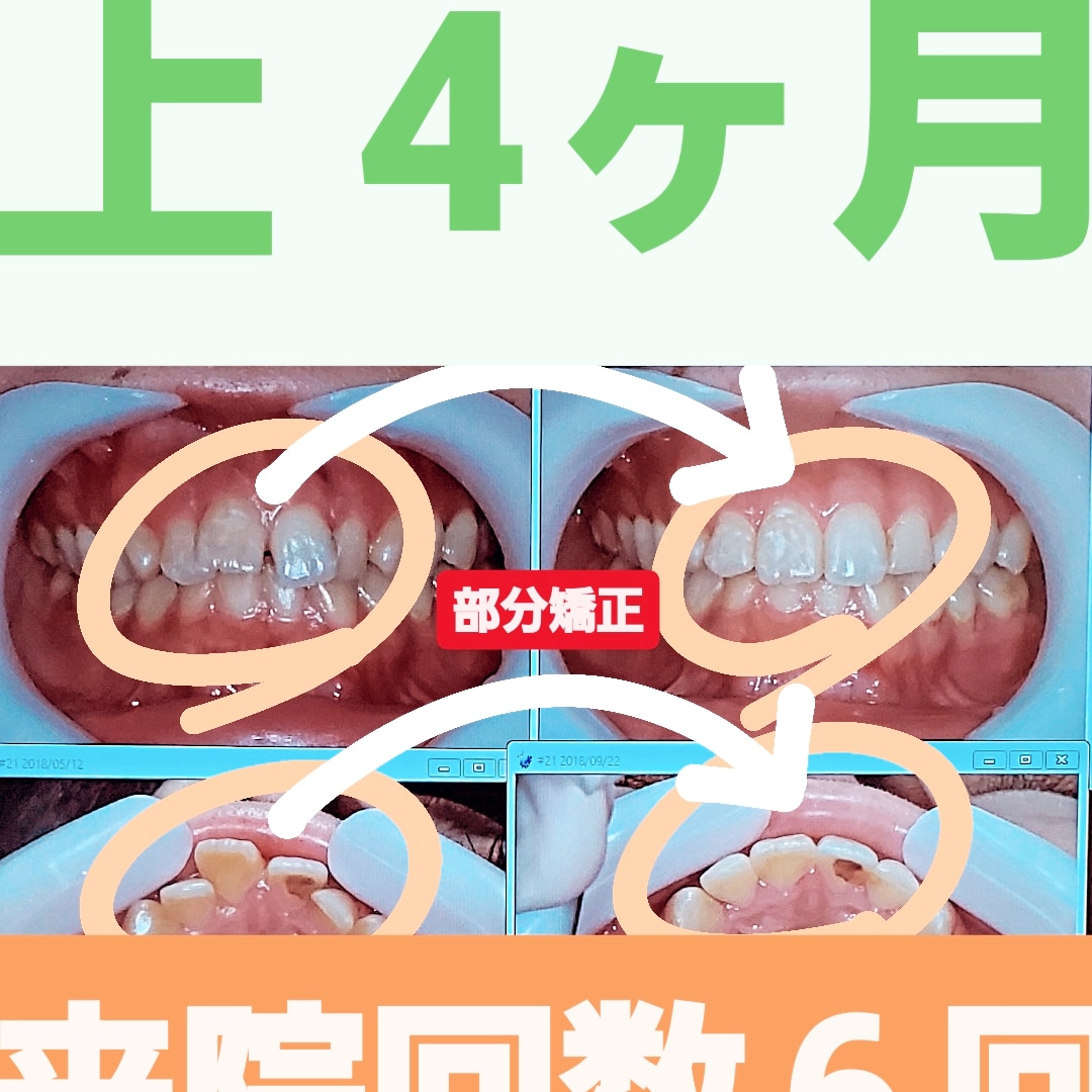 出っ歯+すきっ歯＋非抜歯矯正