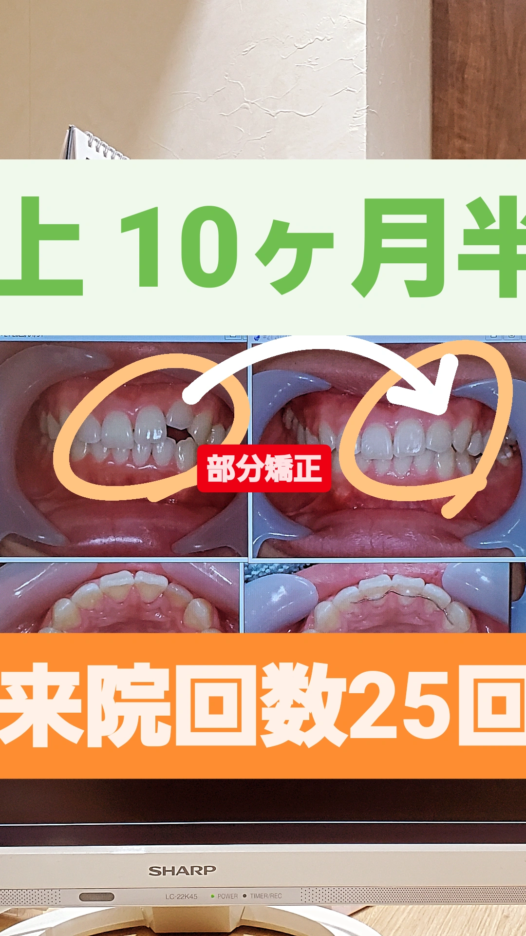 開咬＋非抜歯矯正