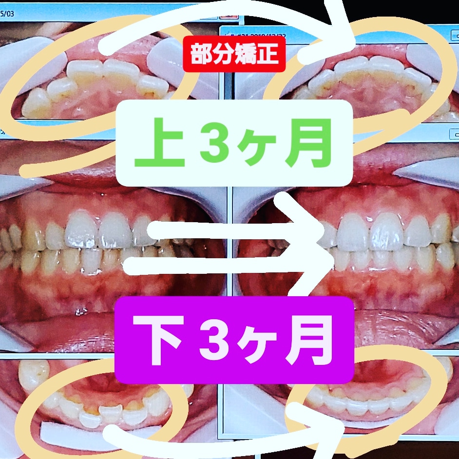 出っ歯＋叢生＋非抜歯矯正