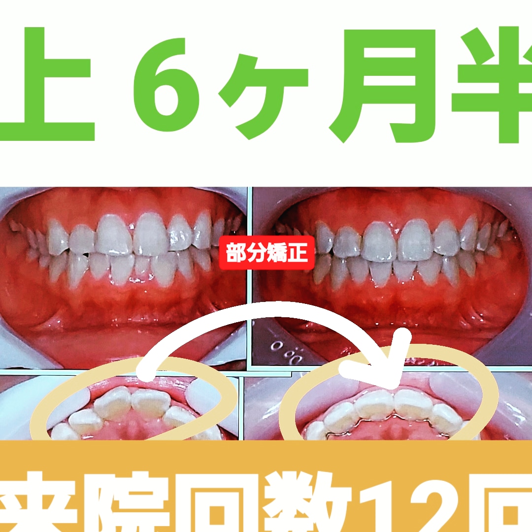 叢生＋非抜歯矯正