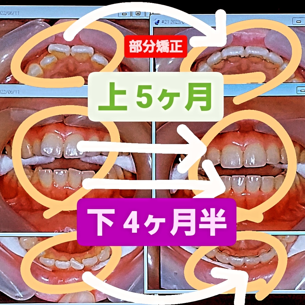 出っ歯＋叢生＋非抜歯矯正