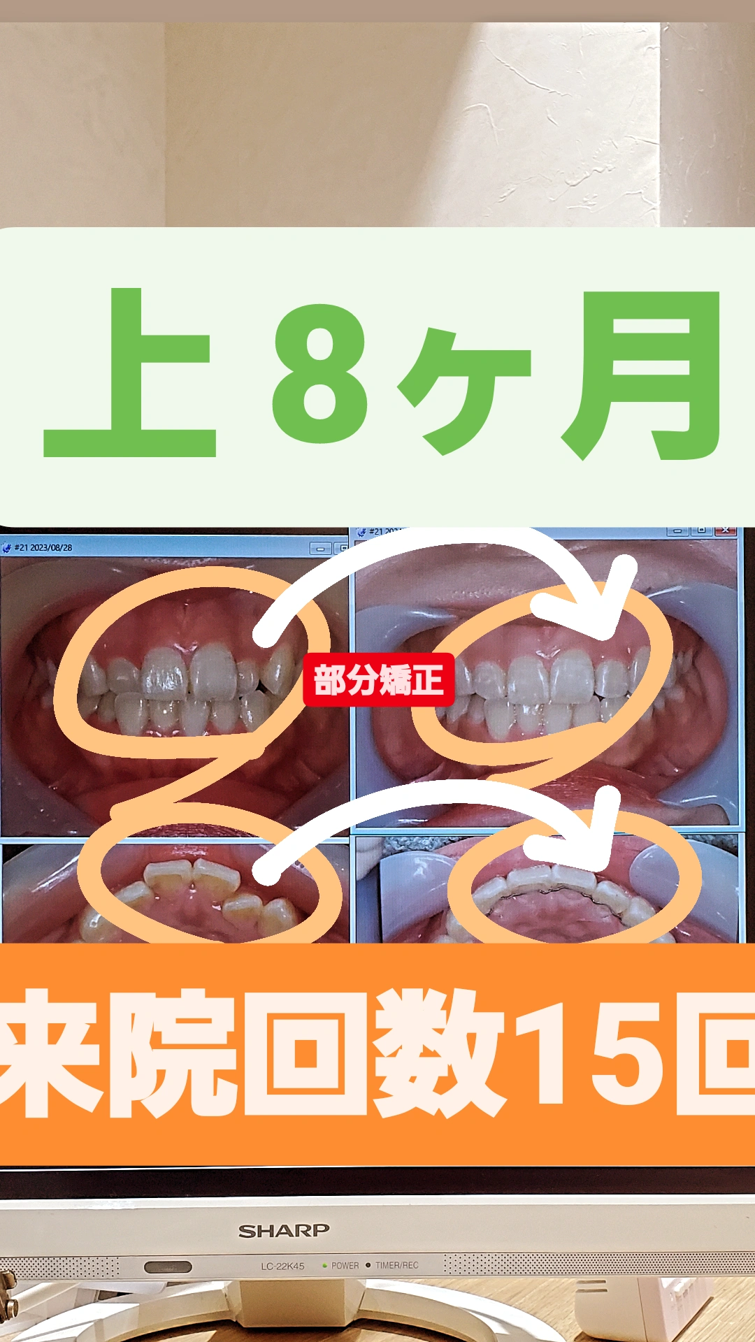 部分的な反対咬合