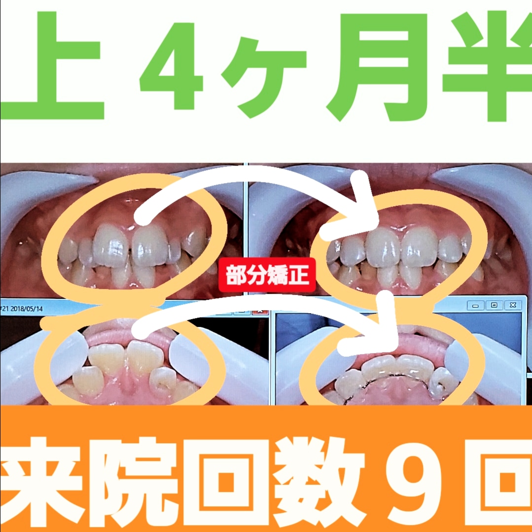 出っ歯+すきっ歯＋非抜歯矯正