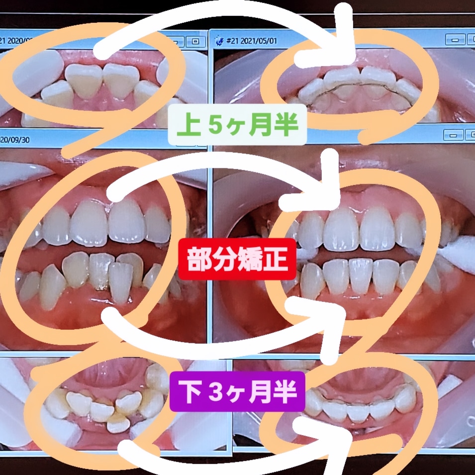 出っ歯＋叢生＋非抜歯矯正