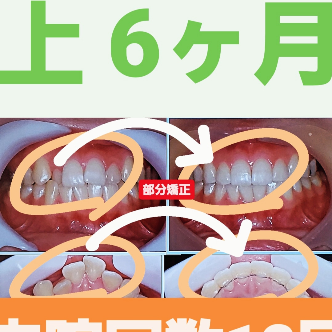 出っ歯＋叢生＋部分的な反対咬合＋非抜歯矯正