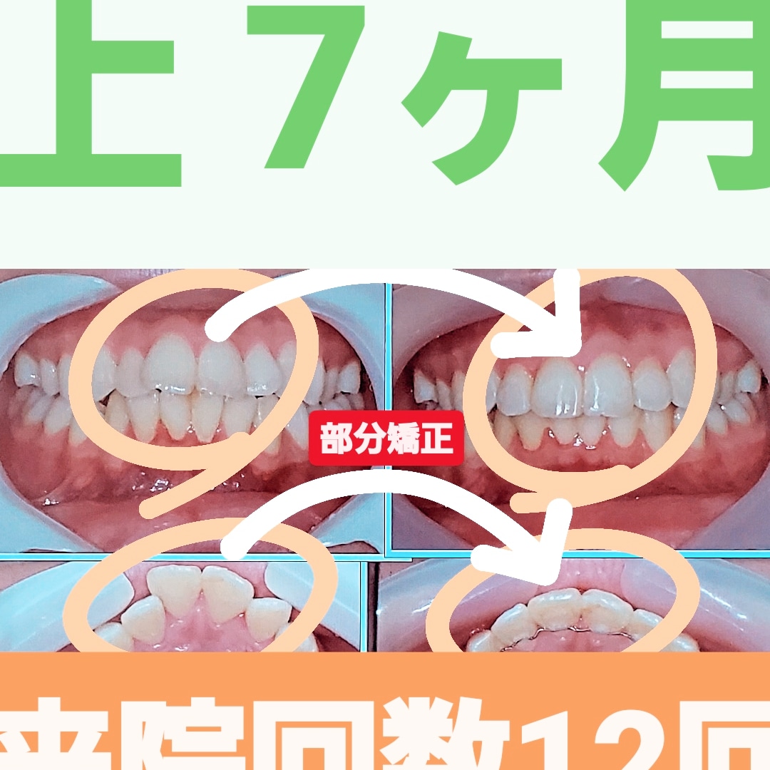 出っ歯＋非抜歯矯正
