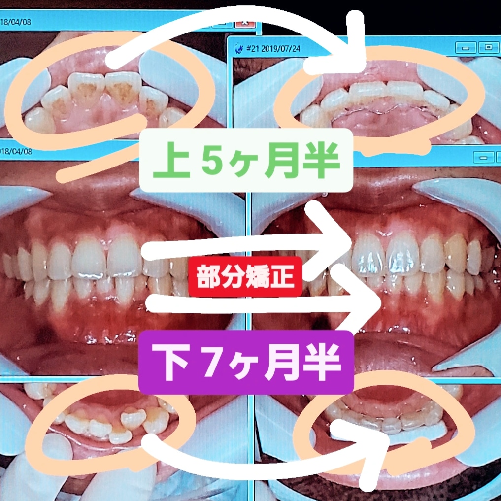 出っ歯＋叢生＋非抜歯矯正