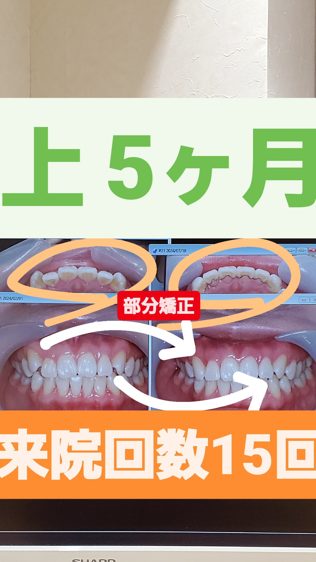 八重歯＋非抜歯矯正