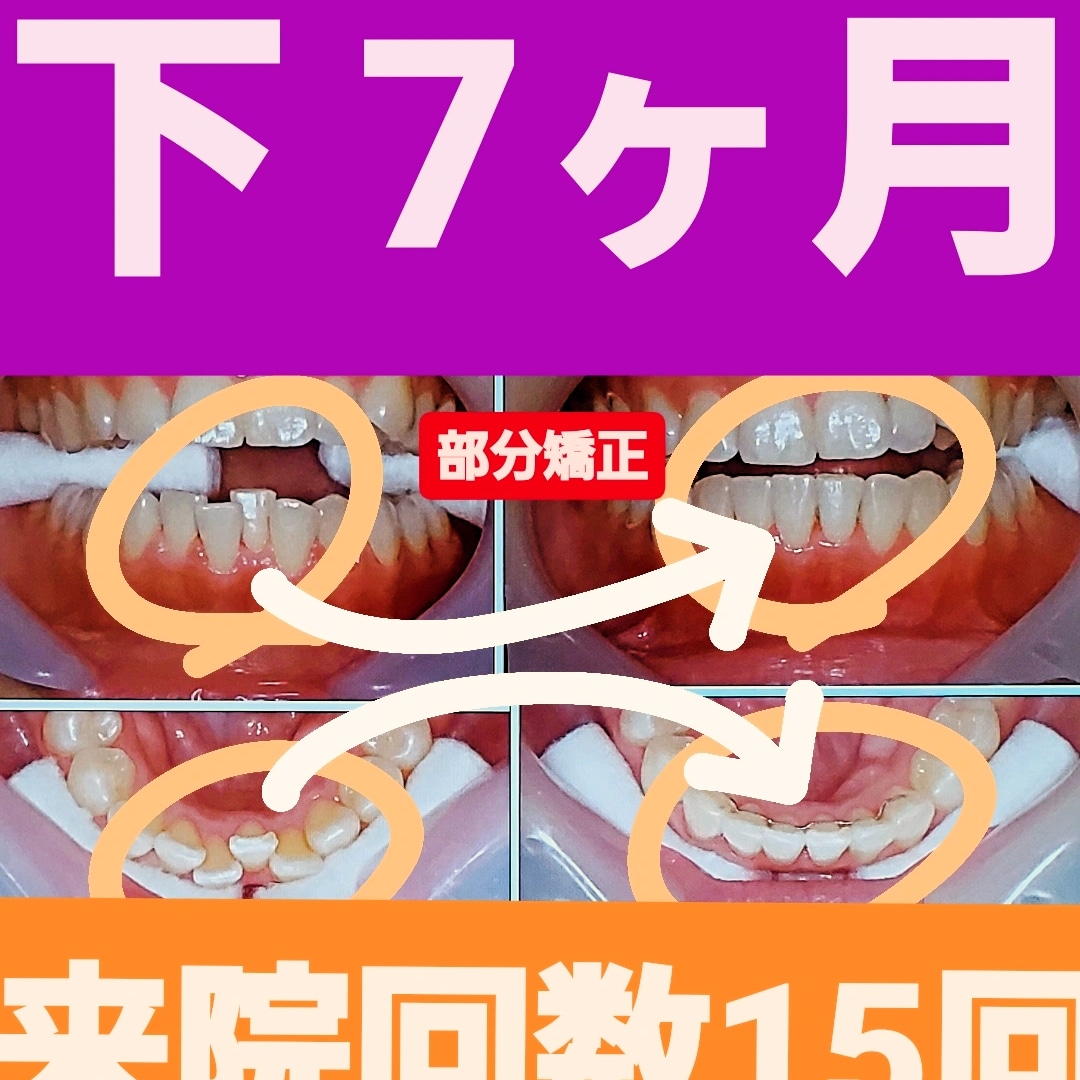 叢生＋非抜歯矯正