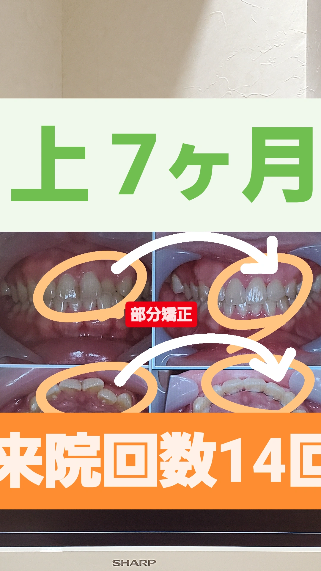 叢生＋非抜歯矯正
