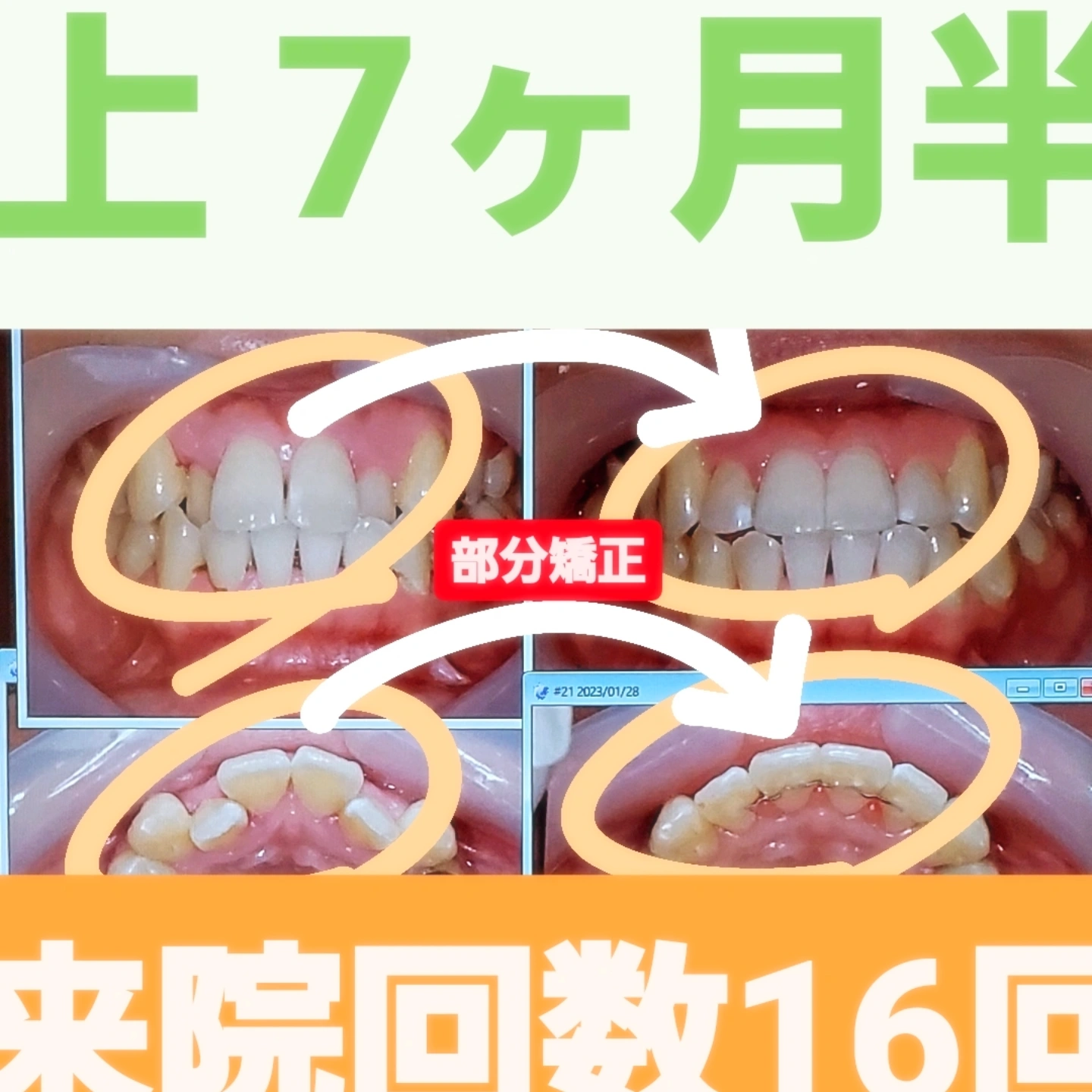 咬合＋叢生＋非抜歯矯正