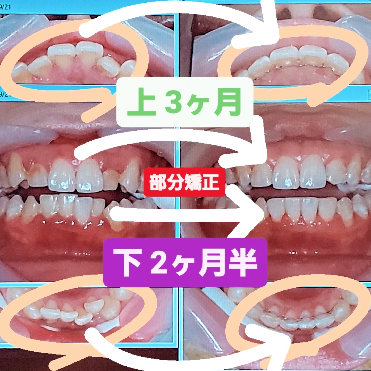 咬合＋叢生＋非抜歯矯正